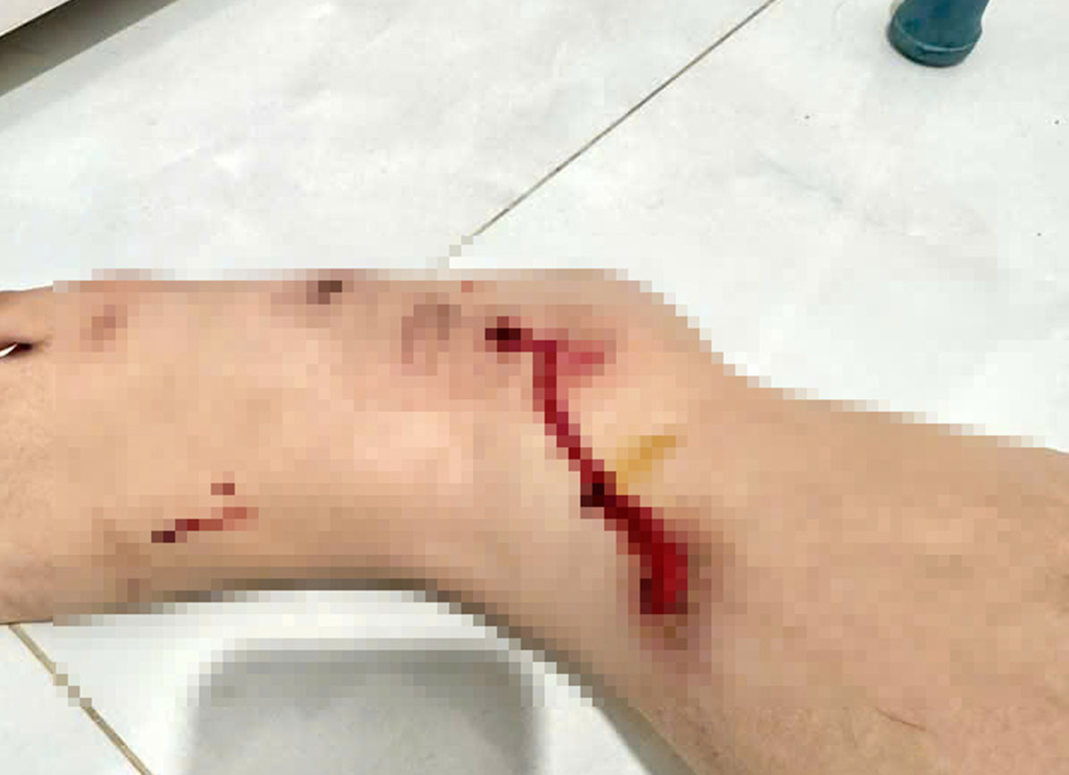 Bị cướp kéo lê trên đường, chân phải chị Tr. bị thương tích, chảy máu nhiều