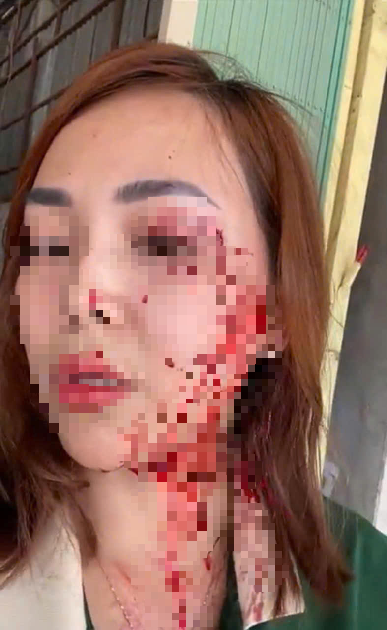 Người phụ nữ xinh đẹp đang đi bị đối tượng lạ rạch mặt - Ảnh 1.