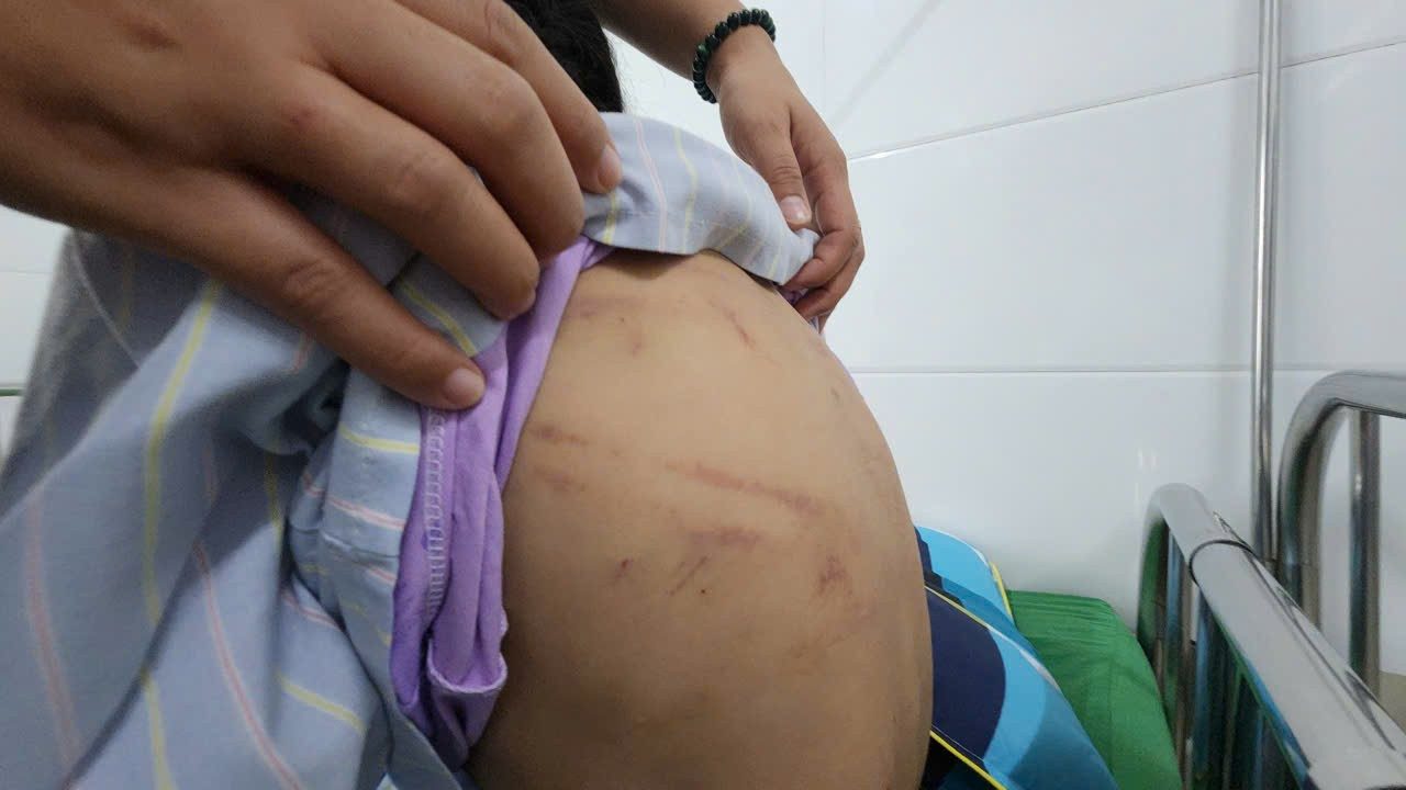 Bé gái bị cha dượng dùng búa bạo hành: Lời kể nghẹn ngào của nạn nhân- Ảnh 2. Bé gái bị cha dượng dùng búa bạo hành: Lời kể nghẹn ngào của nạn nhân- Ảnh 2.