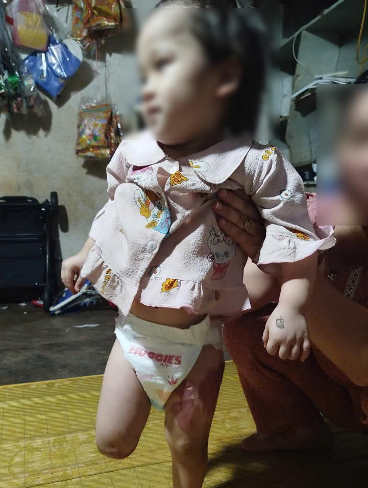 Cháu Như Ý đêm ngày chịu đựng những cơn đau xé lòng sau vụ tai nạn. Ảnh: Lệ Thủy