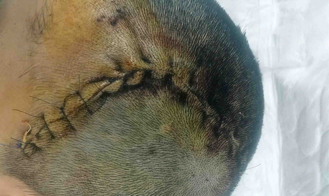 Vụ nam sinh bị đánh chấn thương sọ não ở Nghệ An, vượt ra khỏi trách nhiệm nhà trường