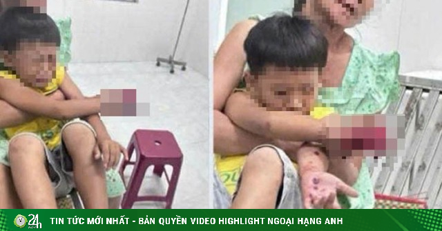 Ảnh minh họa: Cháu bé bị dập bàn tay ngh;i do đ;iện th;oại nổ lúc s;ạc p;in